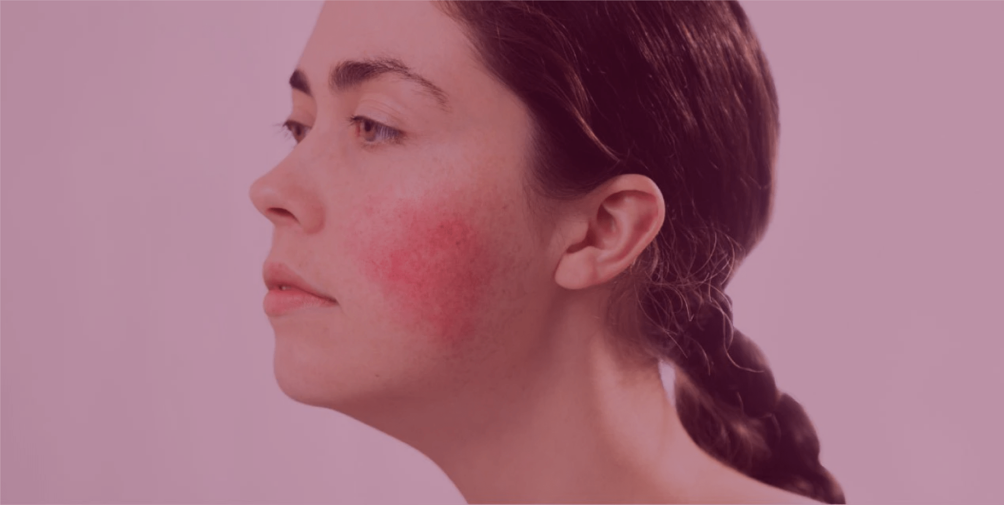 101 on Rosacea