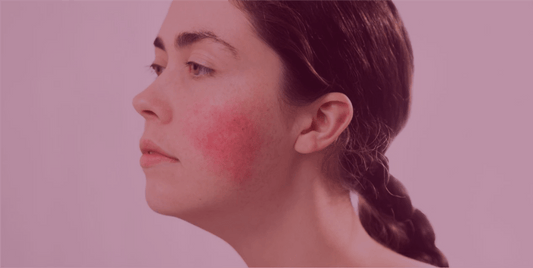 101 on Rosacea - SkinKitz