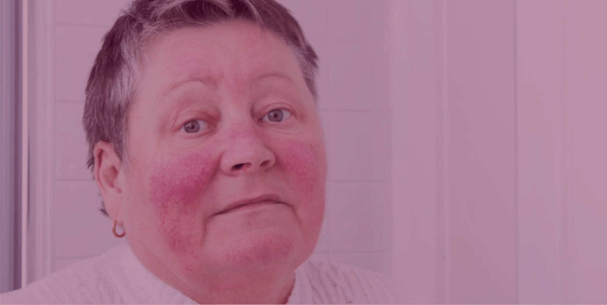 5 Common Questions on Azelaic Acid for Rosacea--Answered