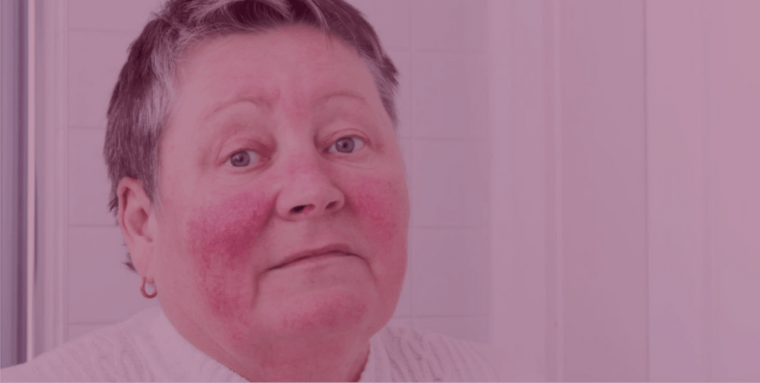5 Common Questions on Azelaic Acid for Rosacea--Answered - SkinKitz