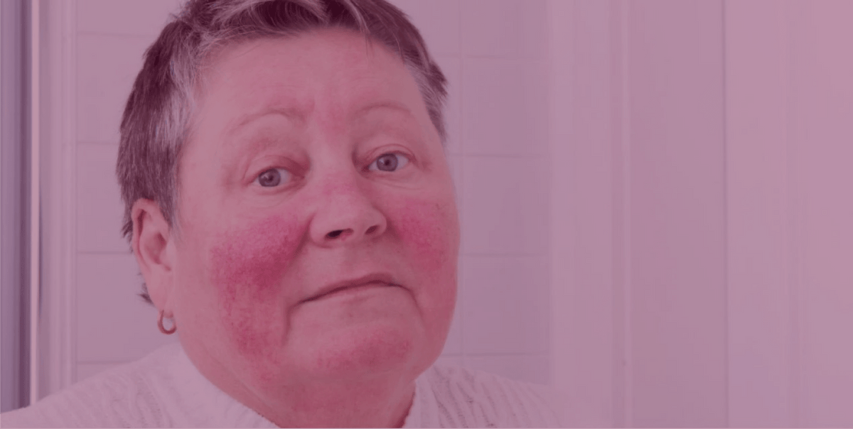 How Exercise Affects Rosacea And What You Can Do About It – SkinKitz