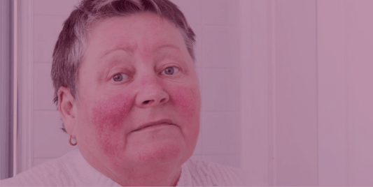 5 Common Questions on Azelaic Acid for Rosacea--Answered - SkinKitz