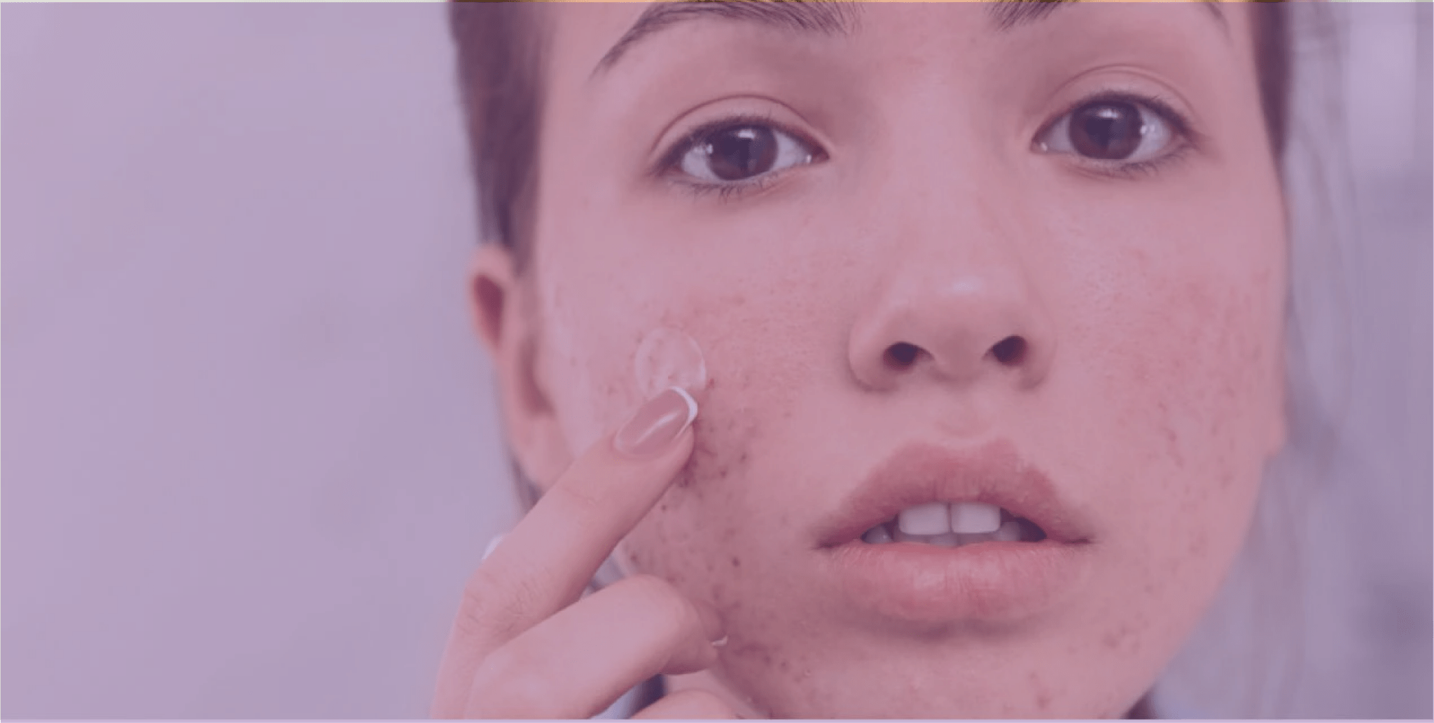 Acne 101: The Basics of Acne