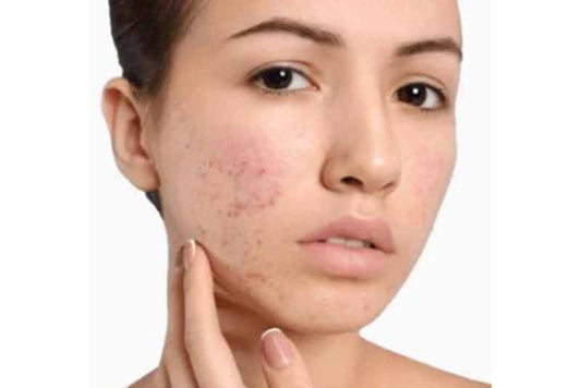 Acne 101: the Basics of Acne - SkinKitz