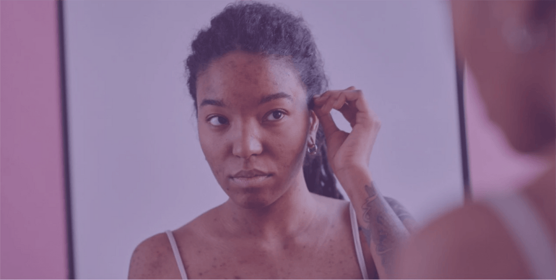 Acne and Scarring - SkinKitz