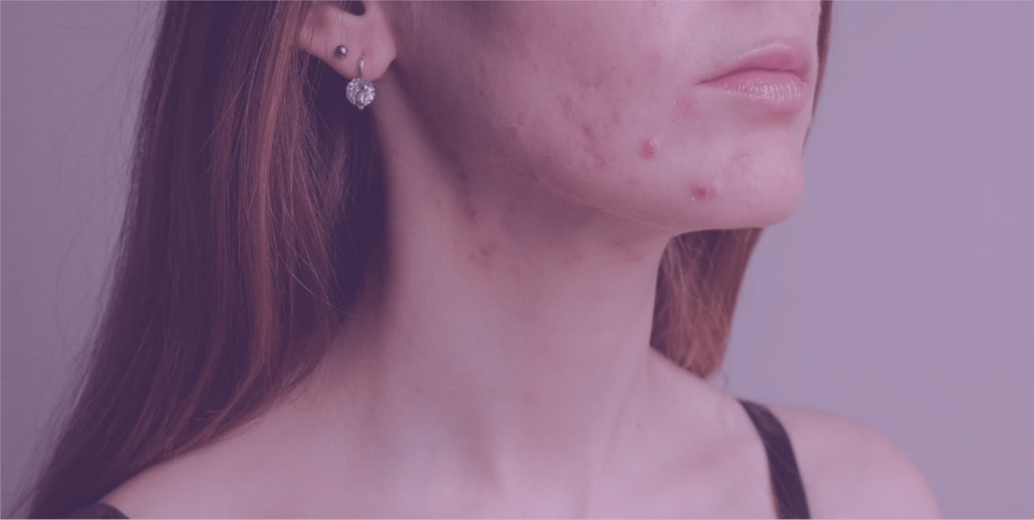 Acne, Pollution, and the Weather