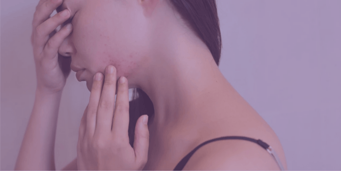 Anxious About Acne - SkinKitz
