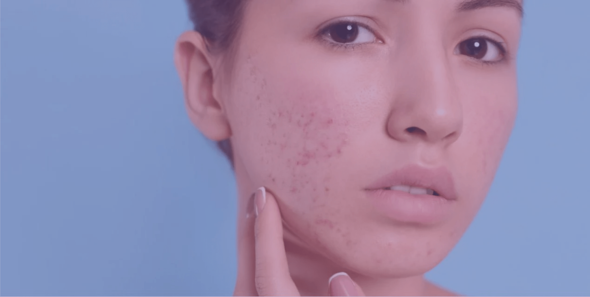 Benzoyl peroxide for acne