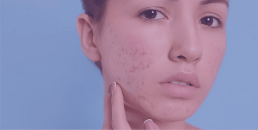 Benzoyl peroxide for acne - SkinKitz