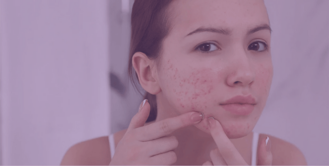 Common Acne-Fighting Ingredients And What They Do - SkinKitz