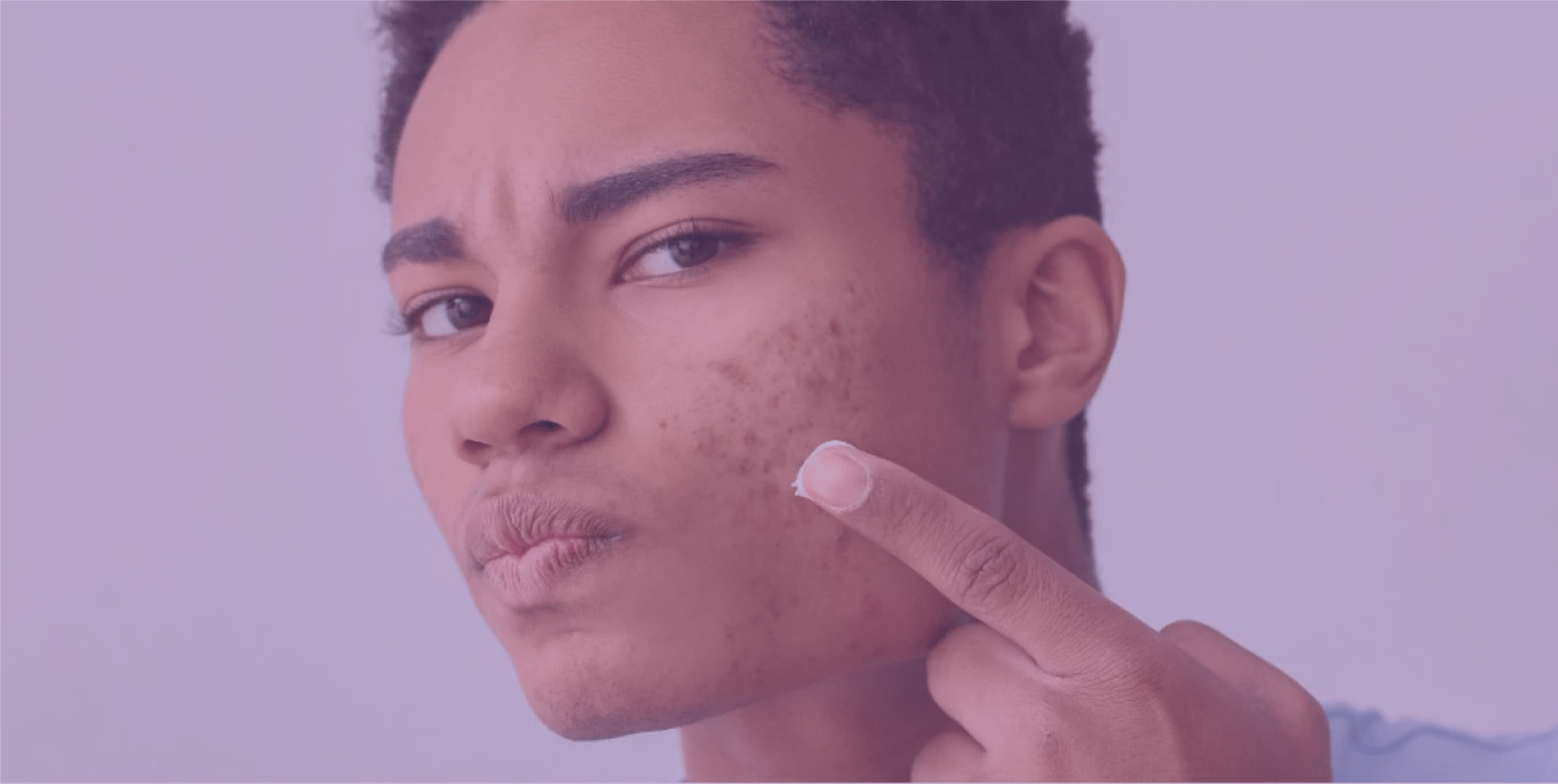 Complementary treatments for acne