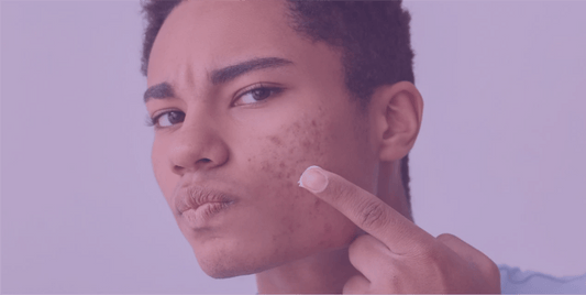 Complementary treatments for acne - SkinKitz