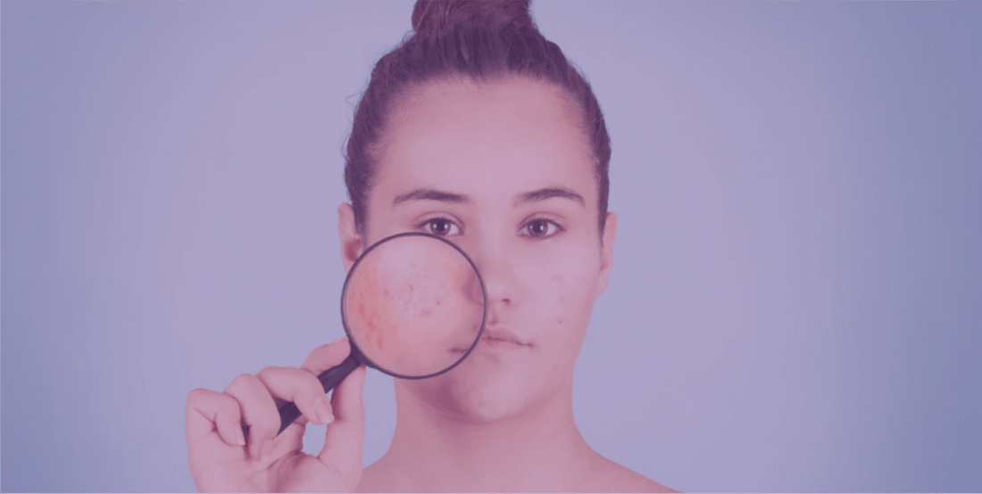 Considerations in using antibiotics for acne - SkinKitz