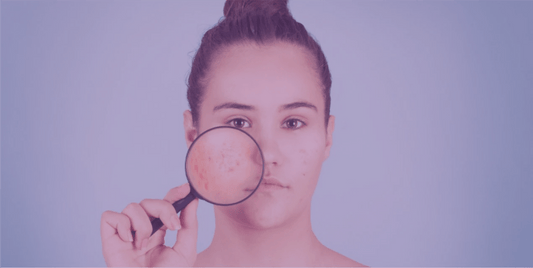 Considerations in using antibiotics for acne - SkinKitz