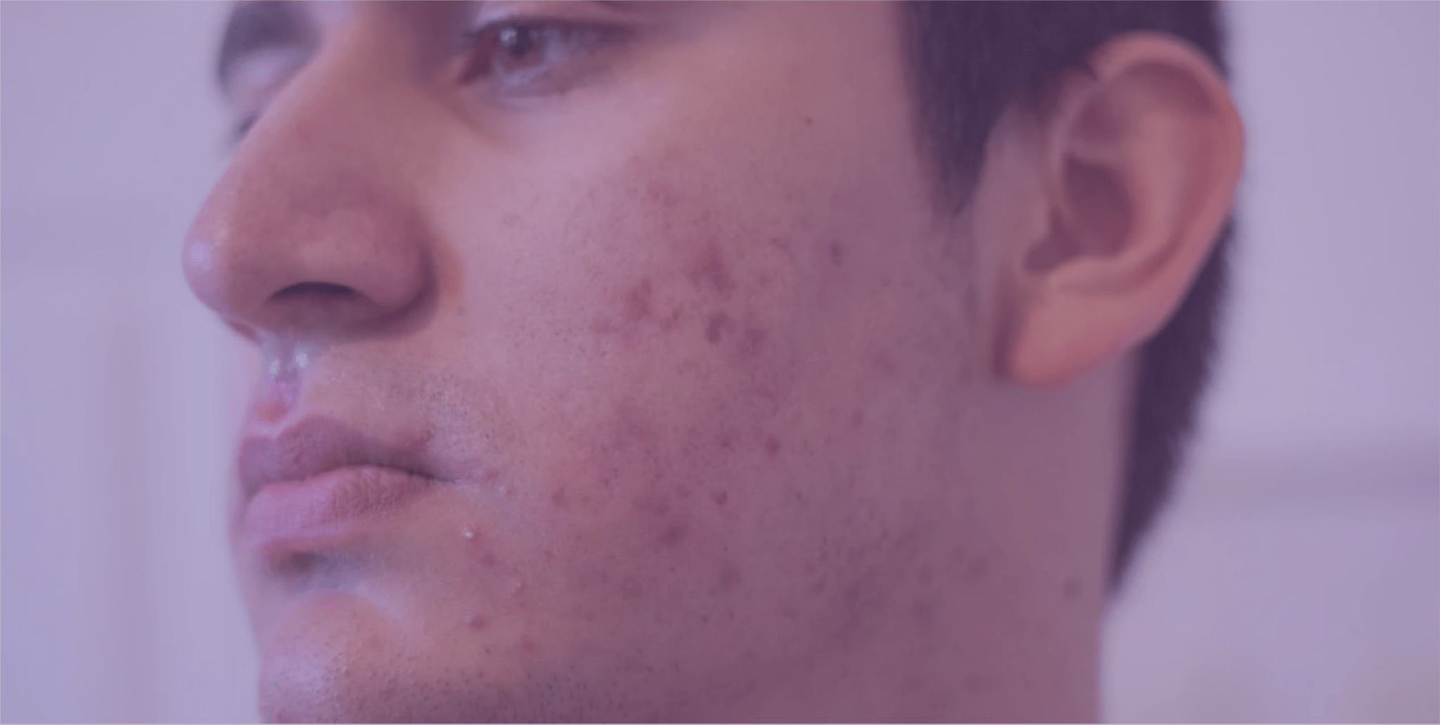 Dealing with Post-Acne Hyperpigmentation