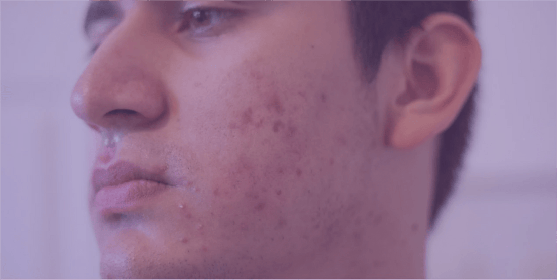 Dealing with Post-Acne Hyperpigmentation - SkinKitz