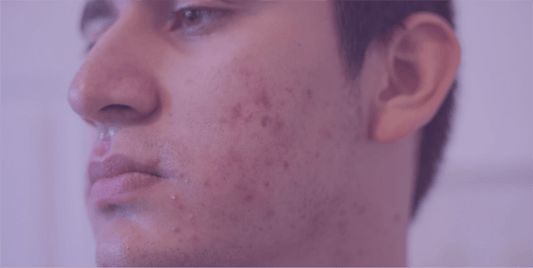 Dealing with Post-Acne Hyperpigmentation - SkinKitz
