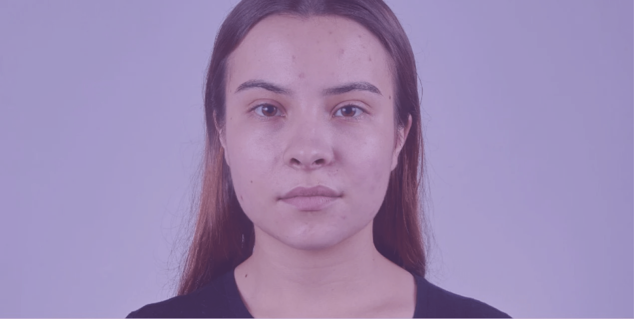 Demystifying Acne Myths - Causes of Acne