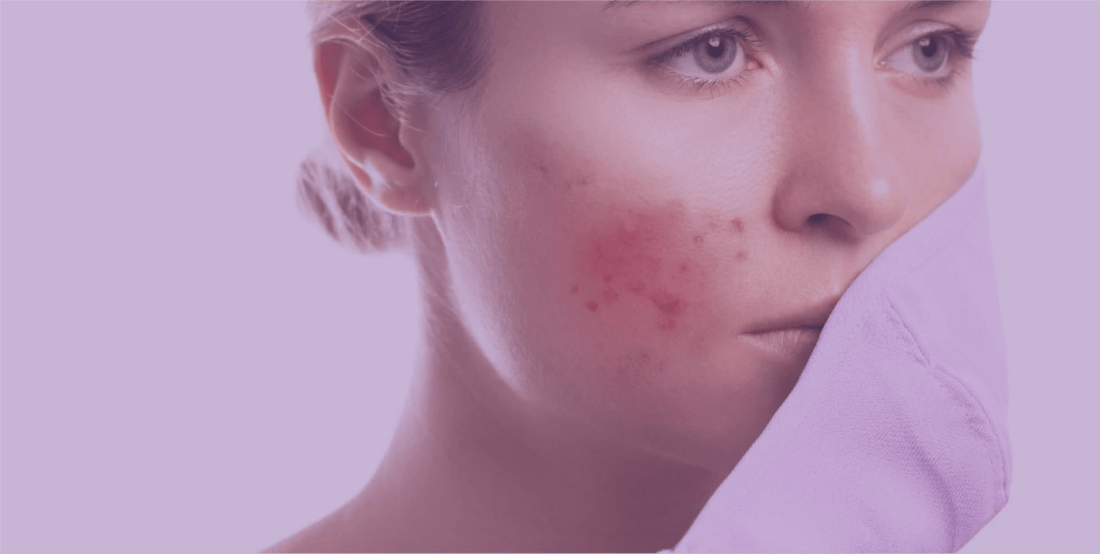 How To Deal With Mask Acne - SkinKitz