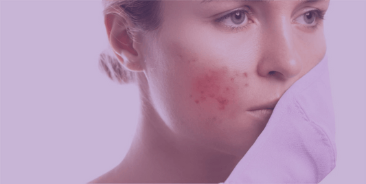 How To Deal With Mask Acne - SkinKitz