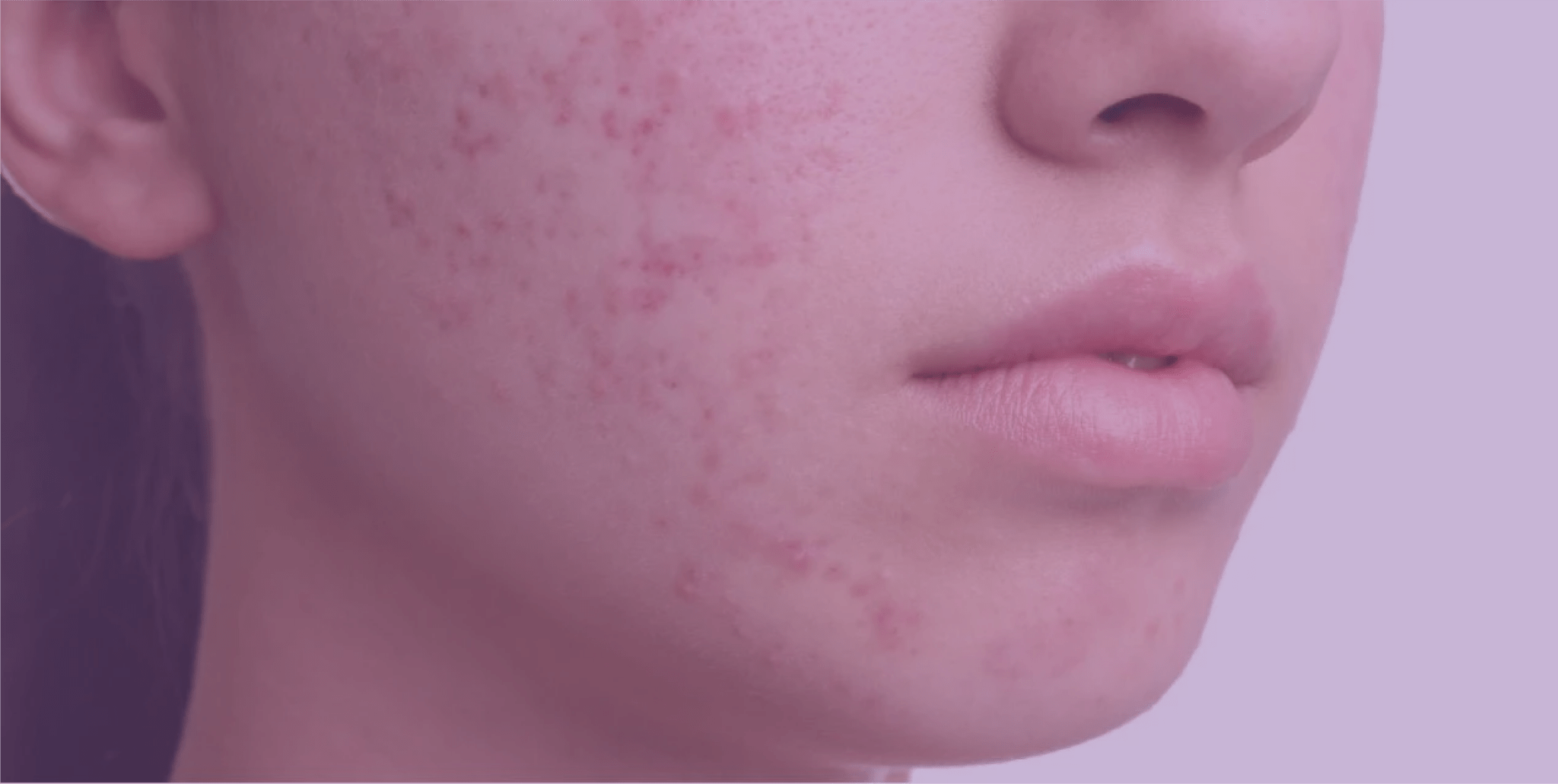 Post Inflammatory Rash How to deal with post-inflammatory erythema of acne – SkinKitz