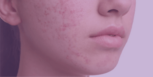 How to deal with post-inflammatory erythema of acne - SkinKitz