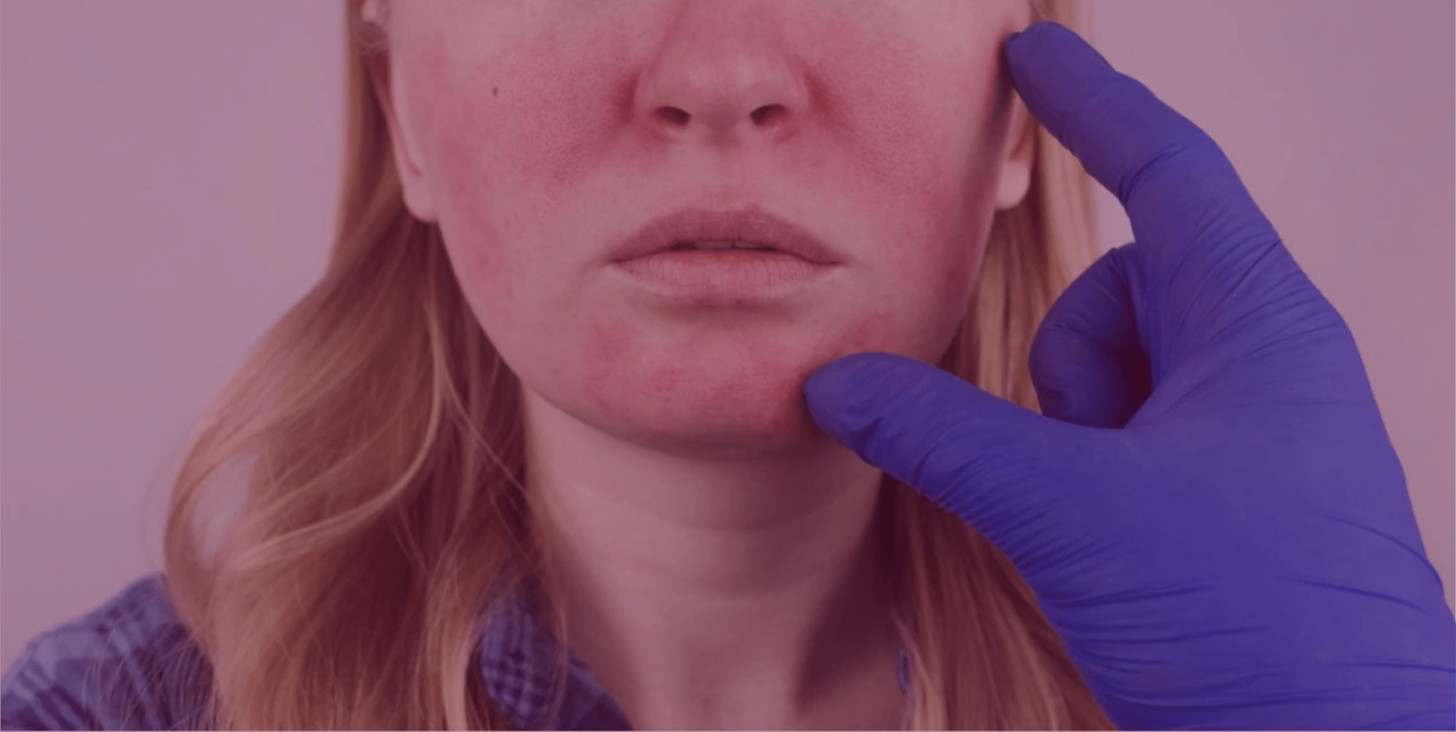 How to Stick to your Rosacea Management Plan