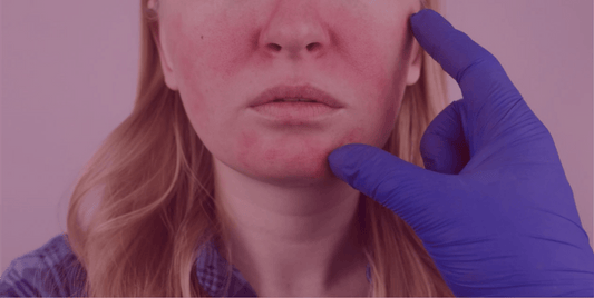 How to Stick to your Rosacea Management Plan - SkinKitz