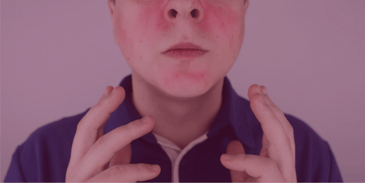 Isotretinoin for rosacea - SkinKitz