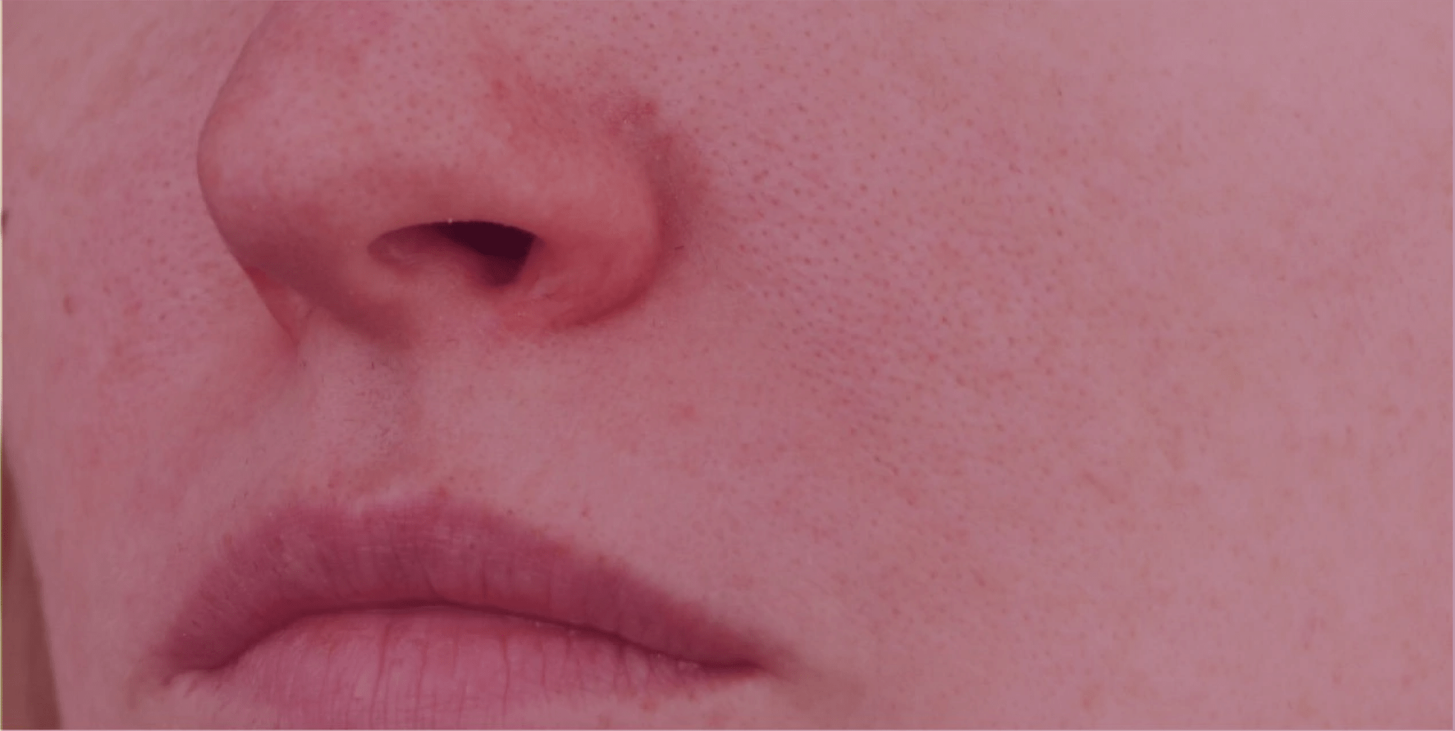 Rhinophyma and Phymatous Changes