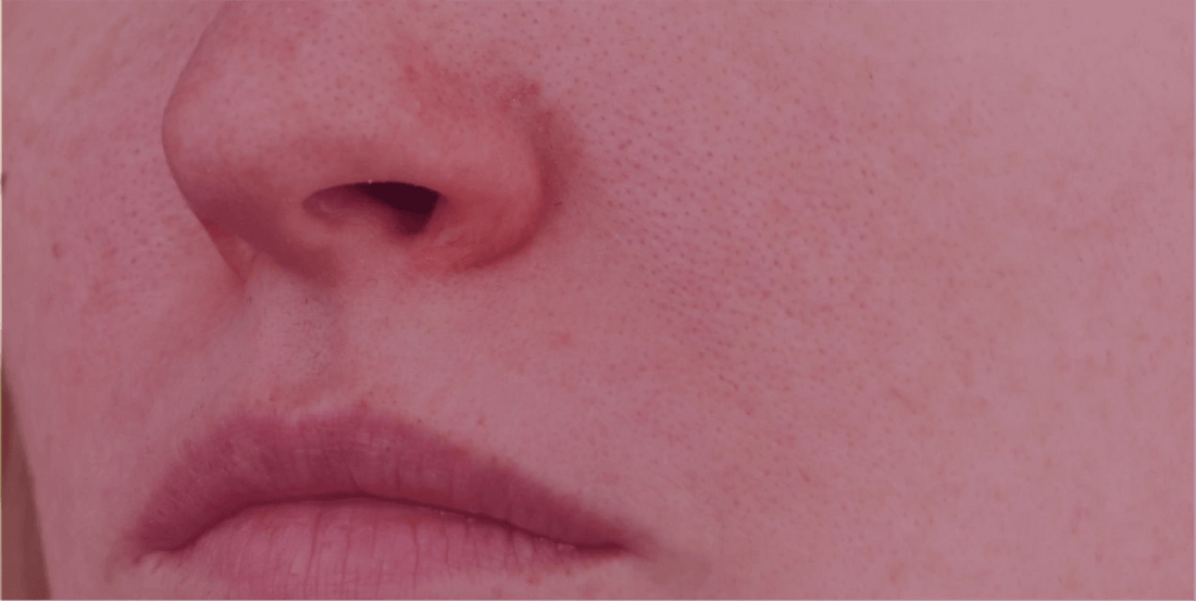 Rhinophyma and Phymatous Changes - SkinKitz