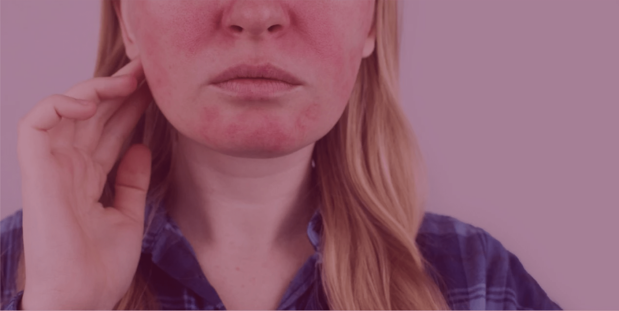 The Role of Oral Antibiotics in Rosacea Management