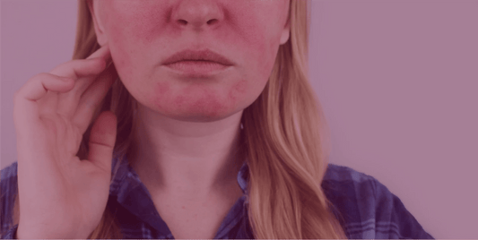 The Role of Oral Antibiotics in Rosacea Management - SkinKitz