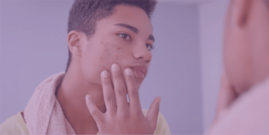 Topical Antibiotics in Acne - SkinKitz