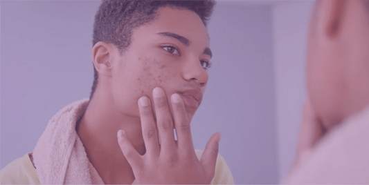 Topical Antibiotics in Acne - SkinKitz