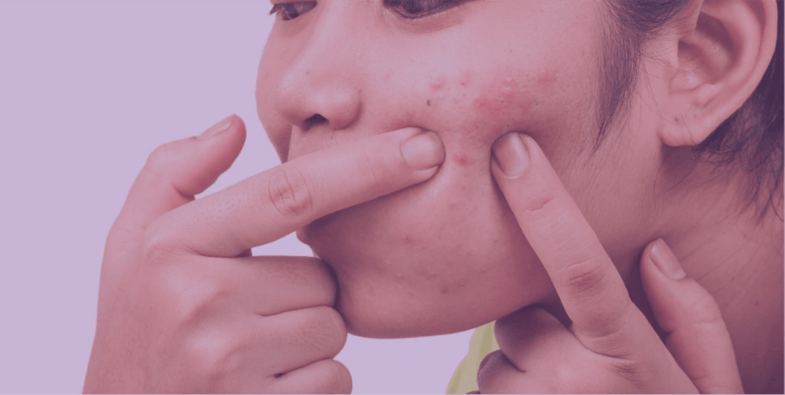 What You're Doing That's Making Your Acne Worse - SkinKitz